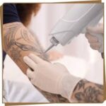 Tattoo Removal in Dubai 3