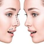 Rhinoplasty in Dubai 2