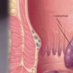 Understanding the Difference Between Piles, Fissure, and Fistula