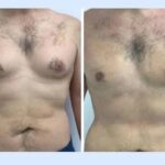 gynecomastia-in-dubai
